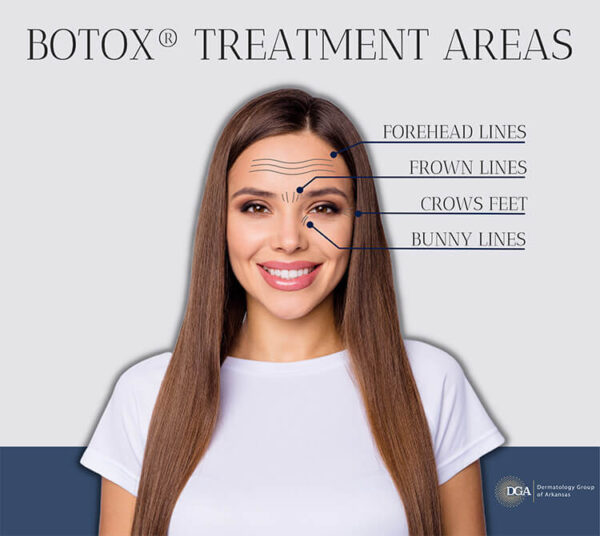 Learn the many uses for BOTOX® at the Little Rock area’s Dermatology Group of Arkansas.