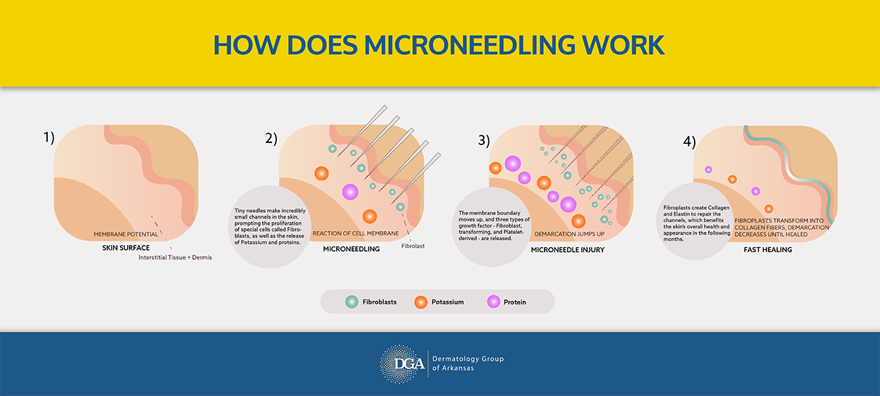 Find out how microneedling at the Little Rock area&rsquo;s Dermatology Group of Arkansas helps revitalize your skin.