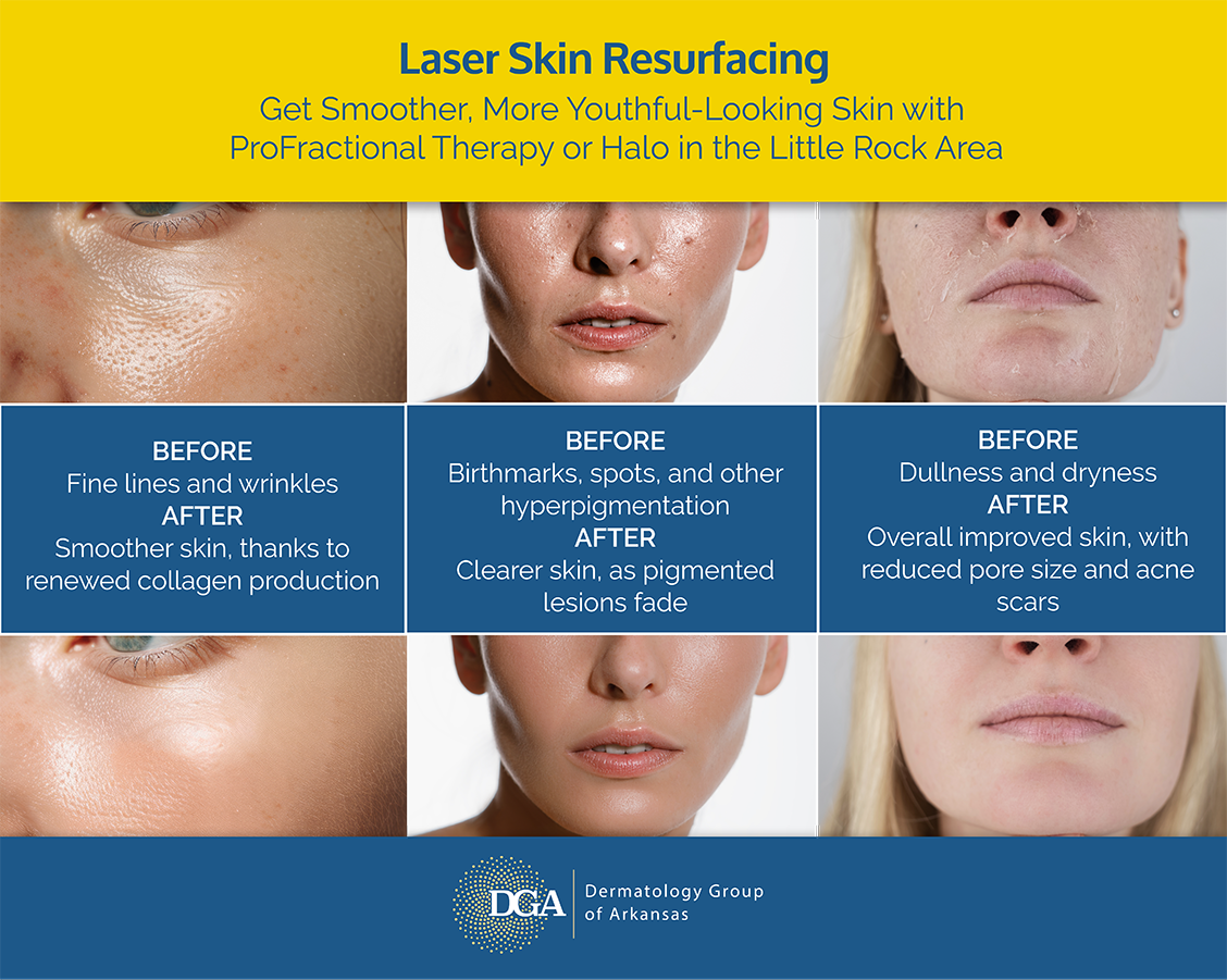 Explore the versatility of laser skin resurfacing at the Little Rock area’s Dermatology Group of Arkansas.