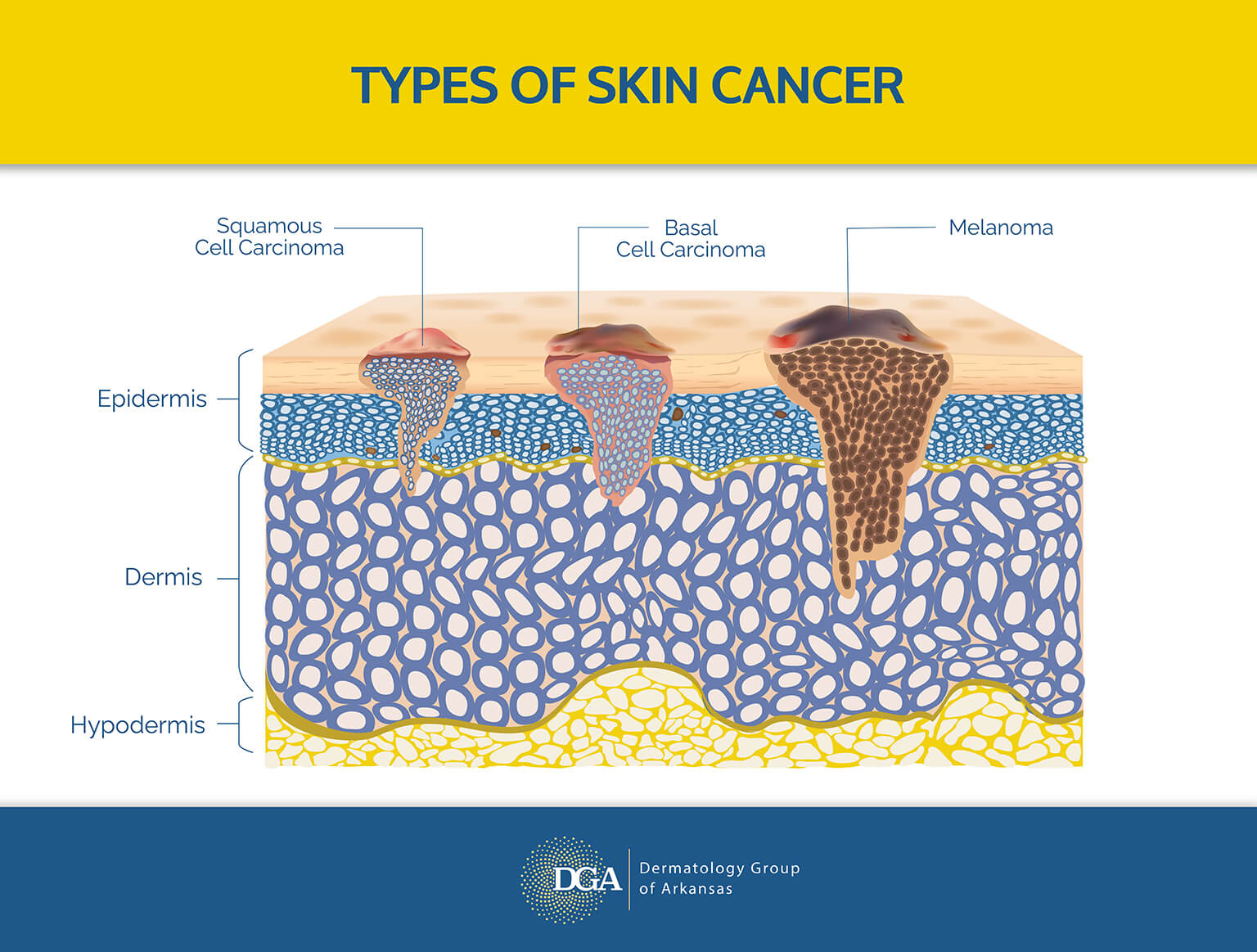 Understand different types of skin cancer with help from the Little Rock area’s Dermatology Group of Arkansas.