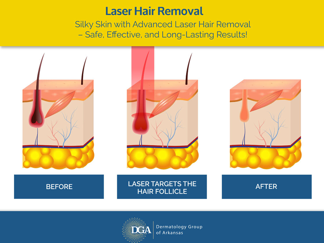 Graphic that shows how the laser hair removal procedure works