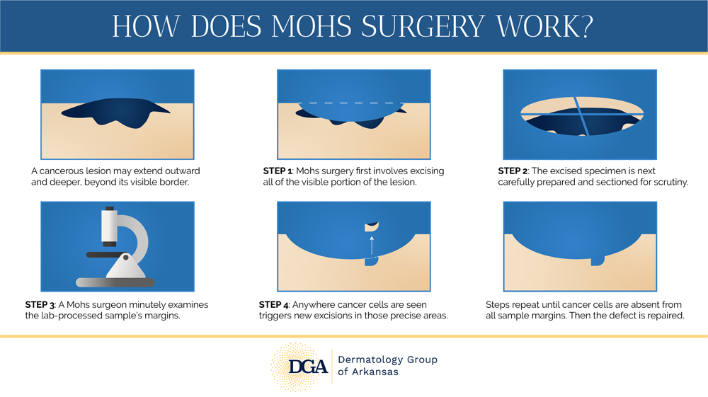 Discover the incredibly efficient and effective steps involved in Mohs surgery at the Little Rock area’s Dermatology Group of Arkansas.