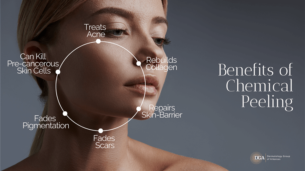 Explore the many benefits of chemical peels from the Little Rock area’s Dermatology Group of Arkansas.