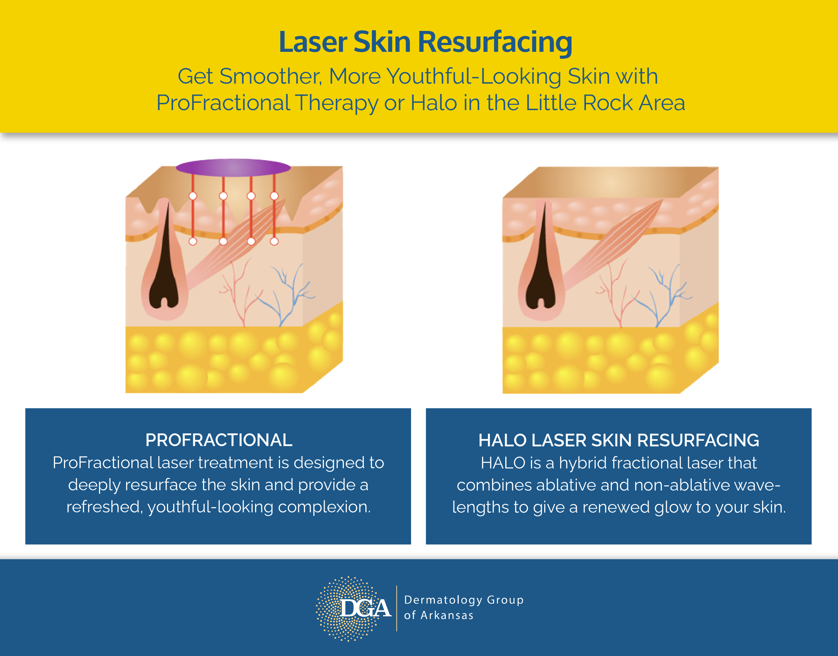 “Infographic comparing ProFractional and HALO laser treatments at the Little Rock area’s Dermatology Group of Arkansas”